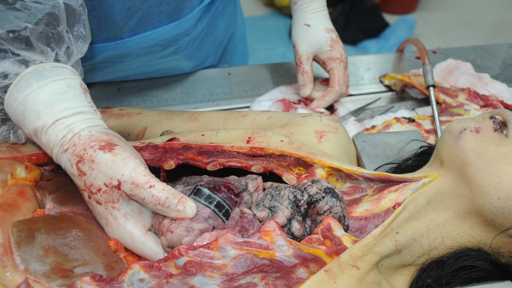 Detailed dissection of stabbed Chinese woman