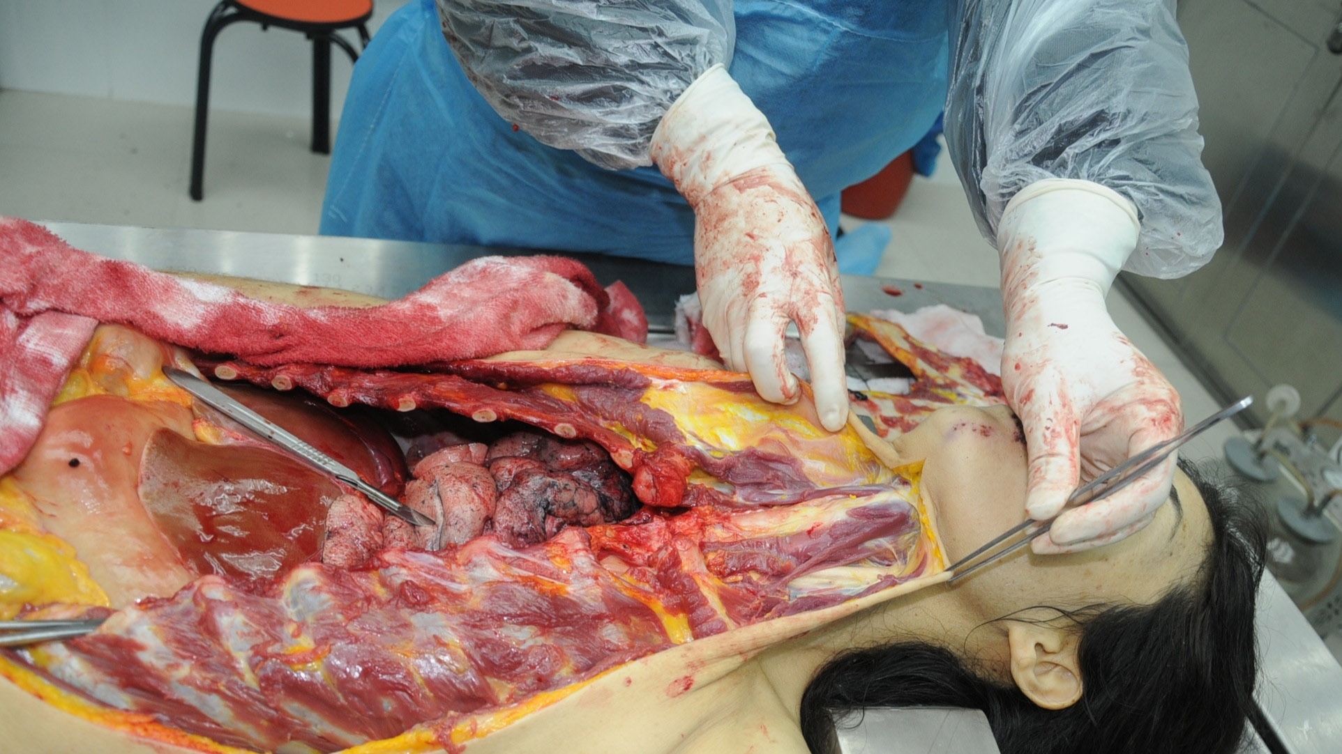 Detailed dissection of stabbed Chinese woman