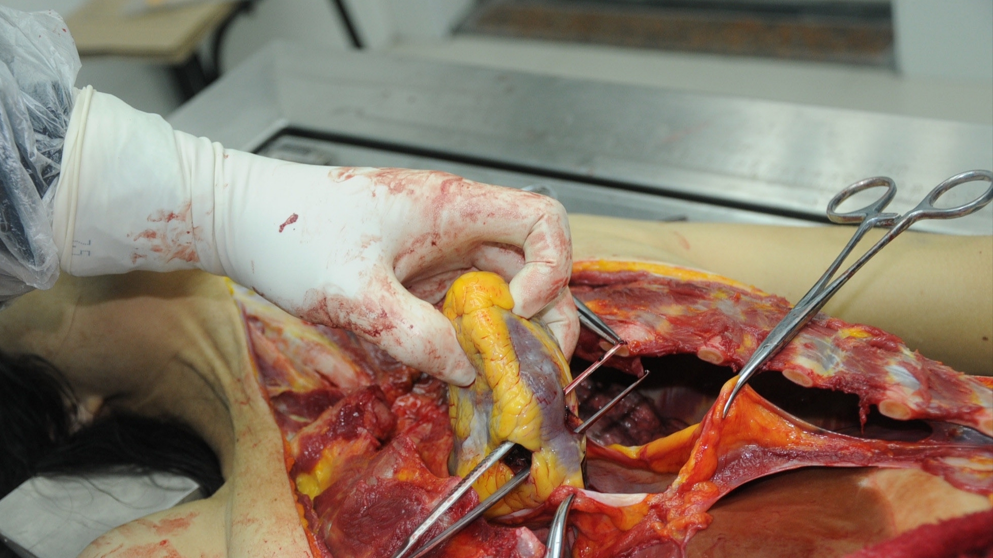 Detailed dissection of stabbed Chinese woman