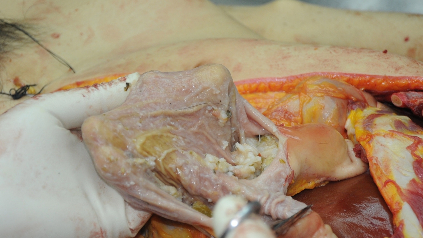 Detailed dissection of stabbed Chinese woman