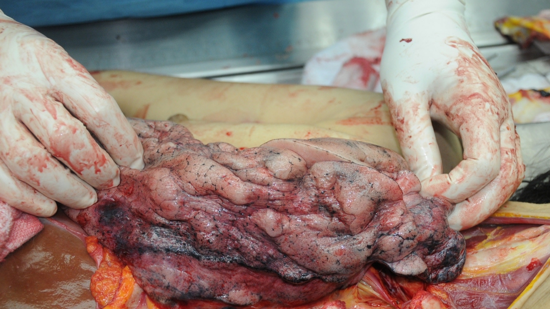 Detailed dissection of stabbed Chinese woman