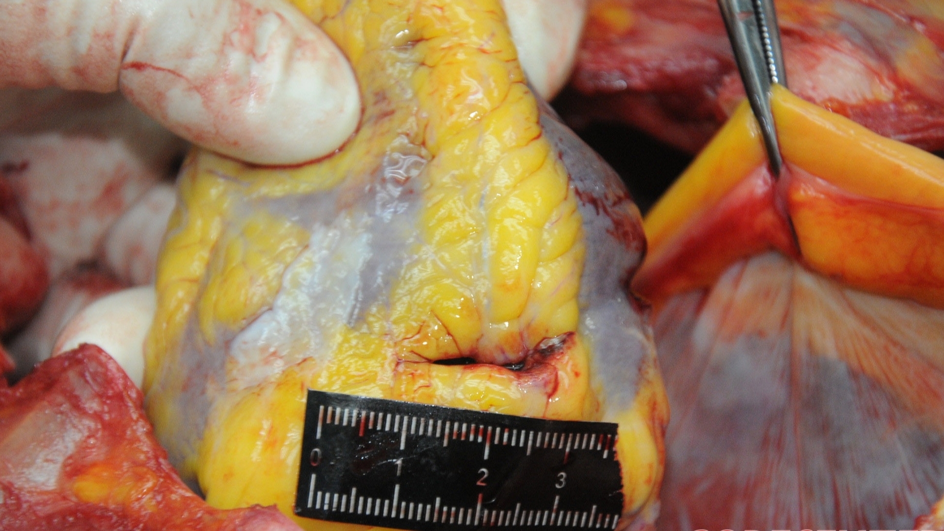 Detailed dissection of stabbed Chinese woman