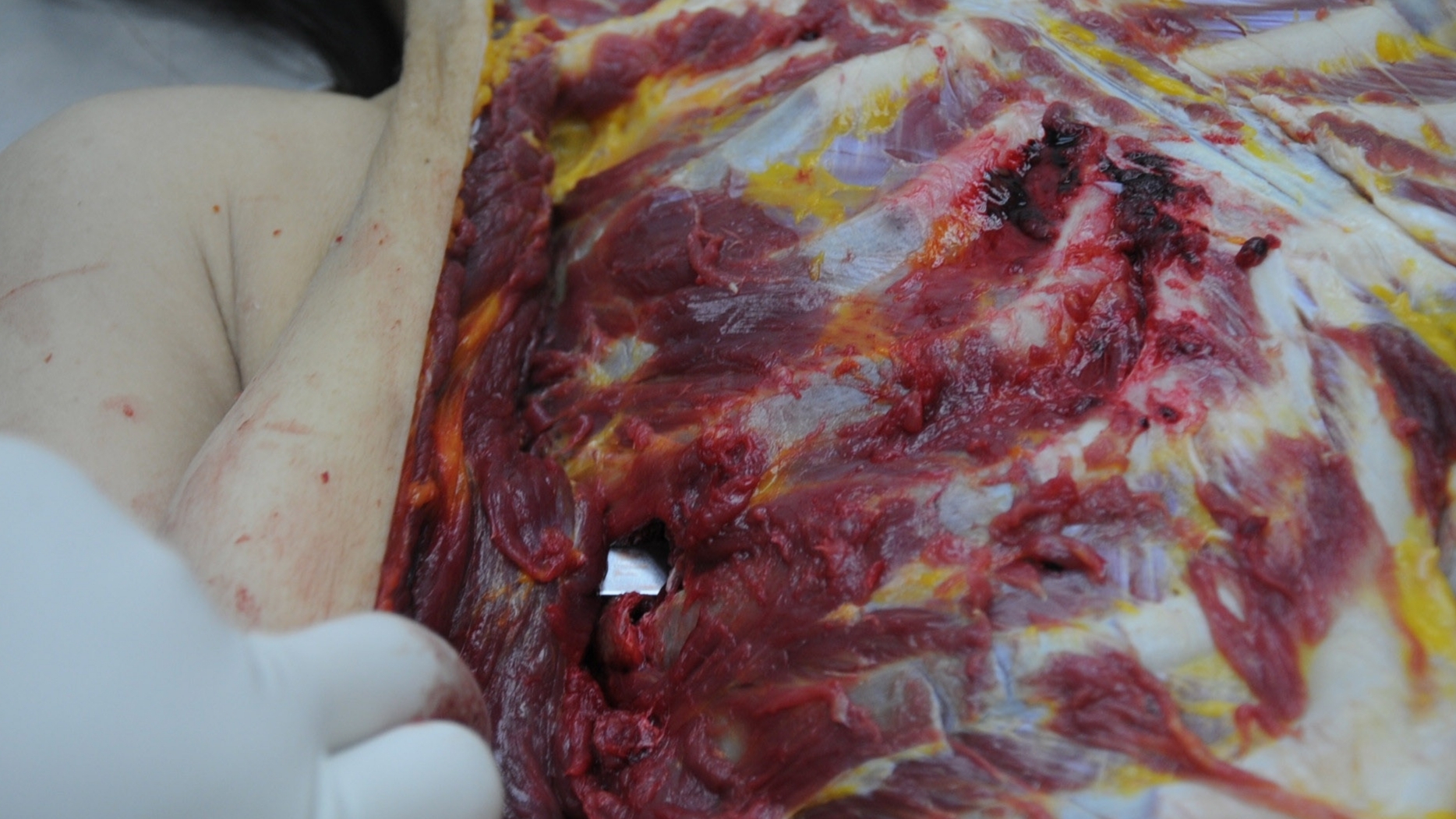 Detailed dissection of stabbed Chinese woman