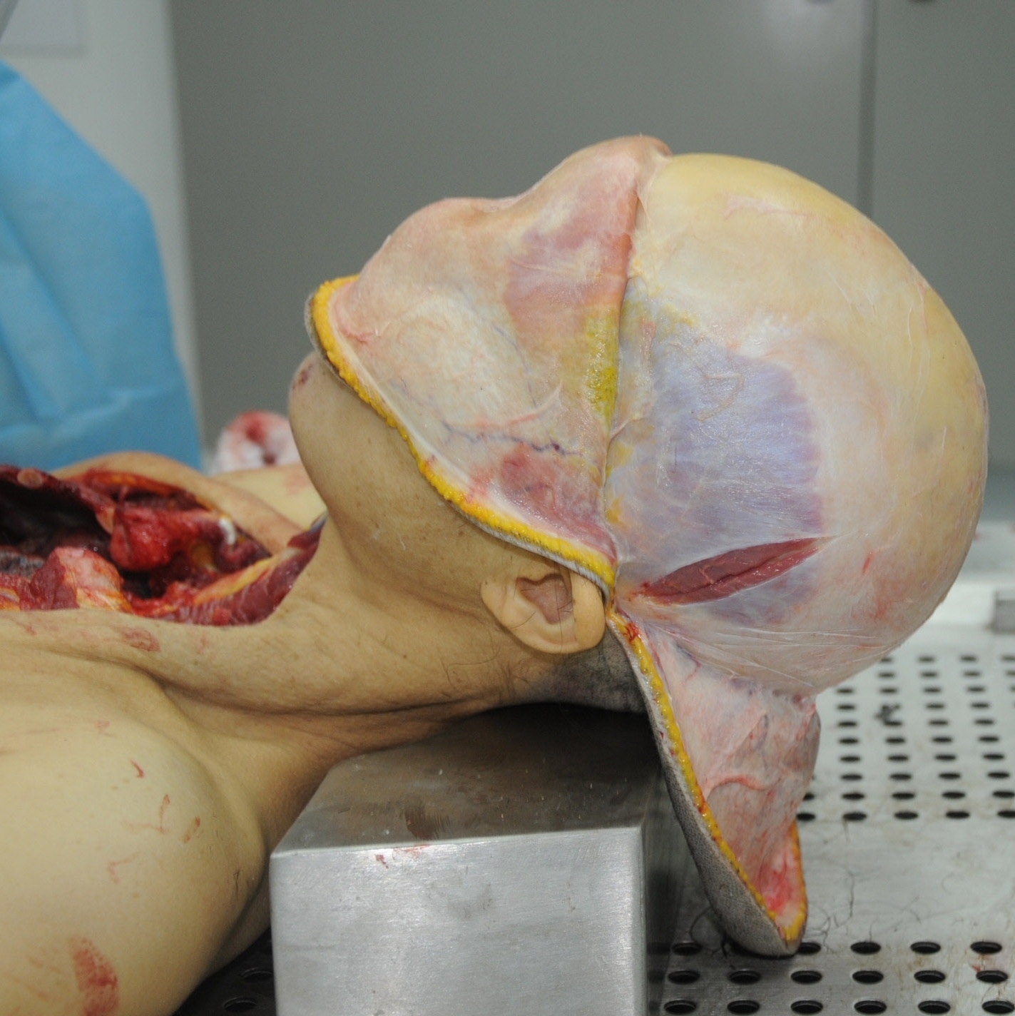 Detailed dissection of stabbed Chinese woman