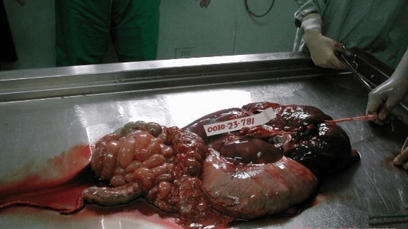 Autopsy of a drug mule