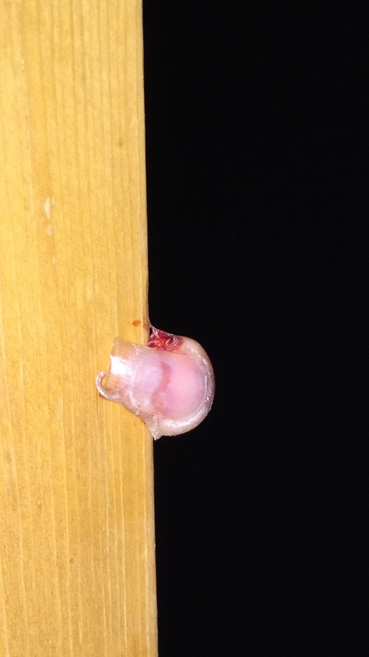 Fingertip amputation