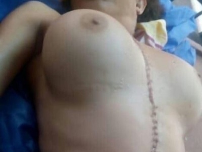 Dead body of busty fake tits prostitute in morgue 