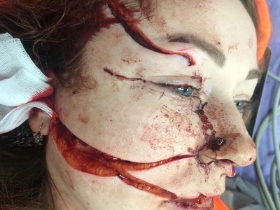 Cute Russian Woman Has Face Slashed by Turkish Husband 