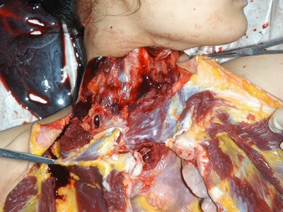 Autopsy of Chinese girl killed by cutting her throat