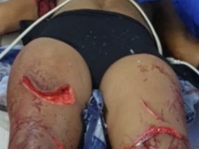 Brazilian woman victime of machete attacks 