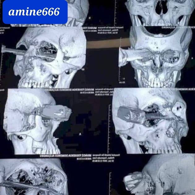 Jordanian military officer accidentally had a knife stuck in his eye