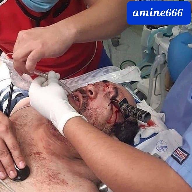 Jordanian military officer accidentally had a knife stuck in his eye