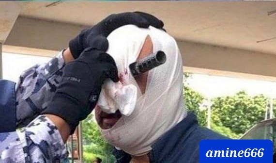 Jordanian military officer accidentally had a knife stuck in his eye