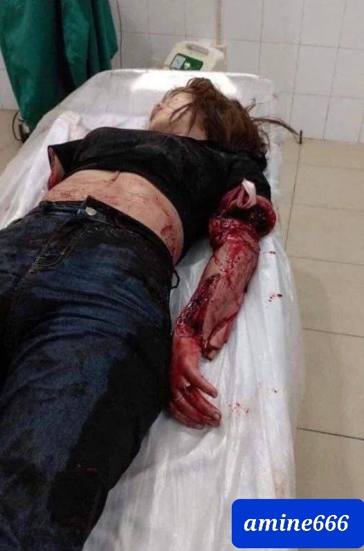 Cute Girl Loses Her Arm in Deadly Accident.