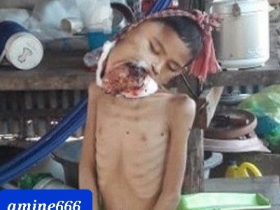 Young man with mouth cancer had enough and commit suicide