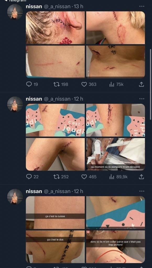 French Teen Is Brutally Assaulted, Slashed by Migrants for Clothing