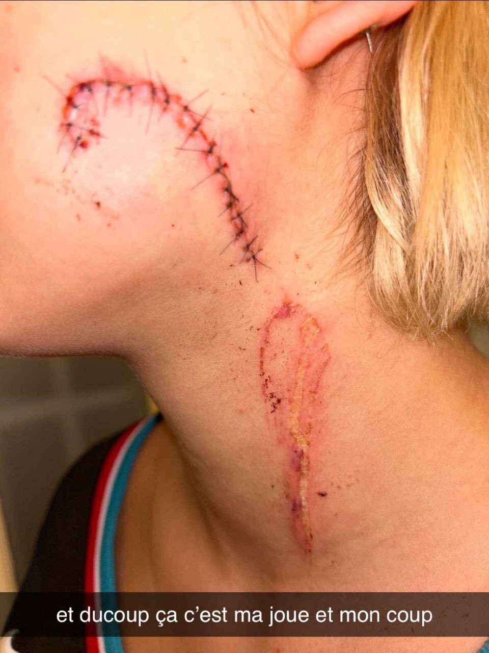 French Teen Is Brutally Assaulted, Slashed by Migrants for Clothing