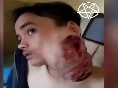 CÃ¢ncer in face chinese boy