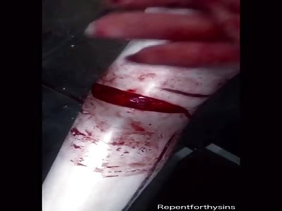 Cutting out more skin and fat from my leg