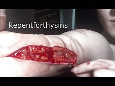 Ripping fat out of my arm.