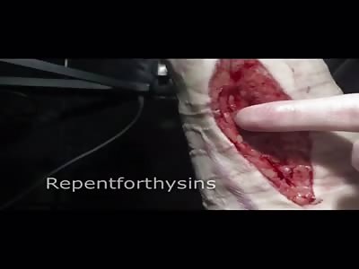 Arm, fascia muscle cut.