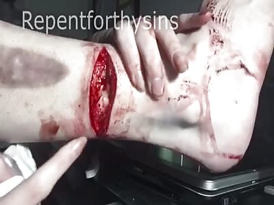 Selfharm down to the bone