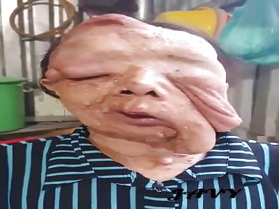 Woman with terrible cÃ¢ncer in face