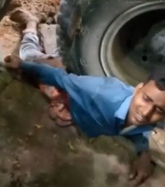 Loses Entire Lower Half of Body. Still Alive!! 