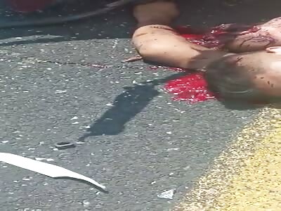 Arm mutilated in accident 