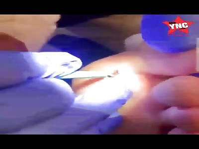 Splinter removal