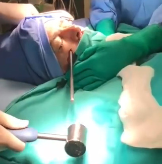 Dude Survives Spear Gun Through Head