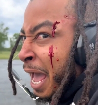 Dude caught shrapnel while blowing stuff up