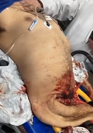 Guy loses half of his body and is still alive (2 videos)