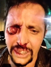 A man lost an eye in an attempt to steal his motorcycle