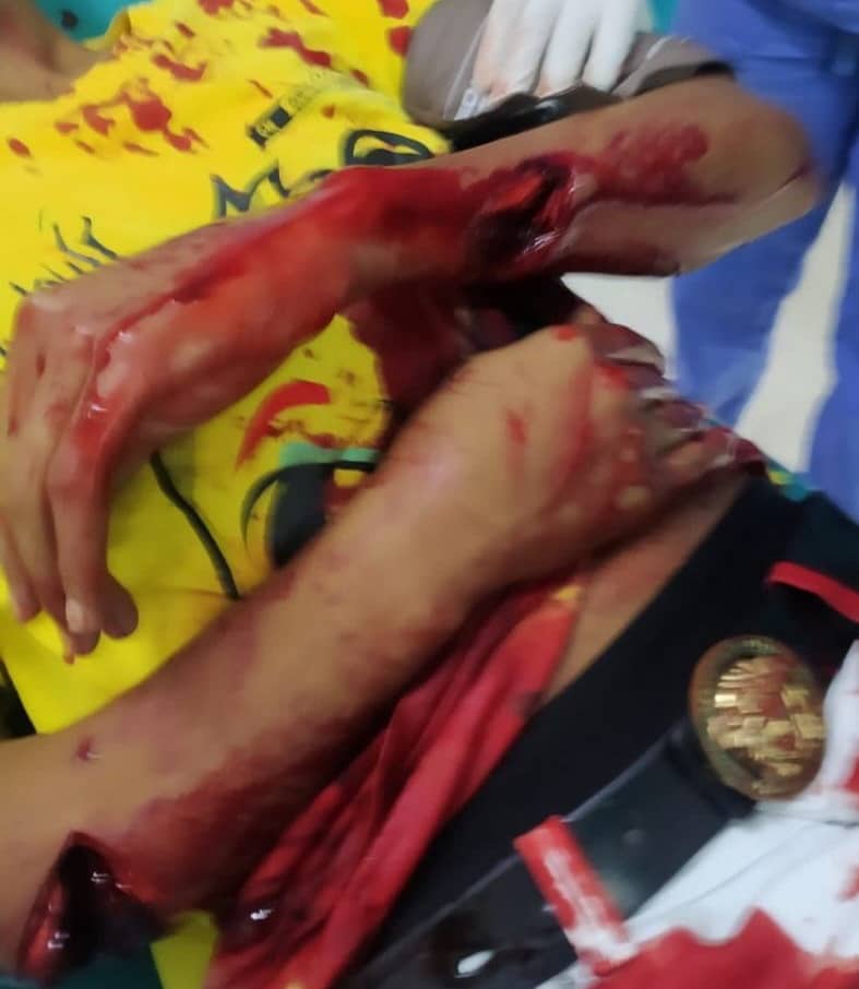 Machete fight ends badly