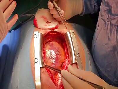 Surgery To Remove Shrapnel