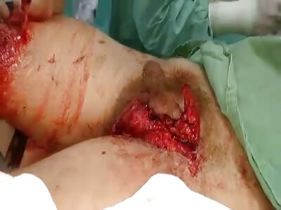 Victim of accident with destroyed scrotal