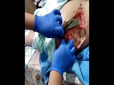 Woman has infected butt implants.