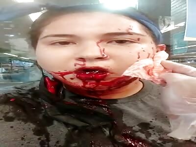 Woman shot in the mouth.