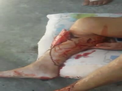 Man with compound fracture after being hit by car