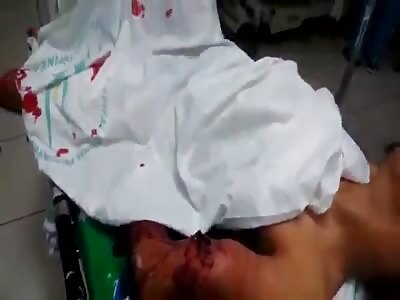 Badly broken victim is treated in hospital.