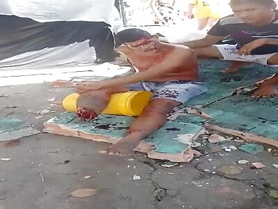 Motorcyclist has his leg severed in an accident