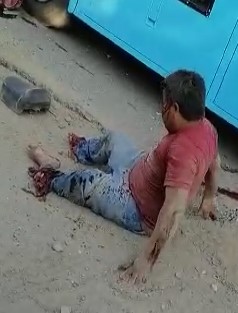 Poor accident victim had his legs crushed