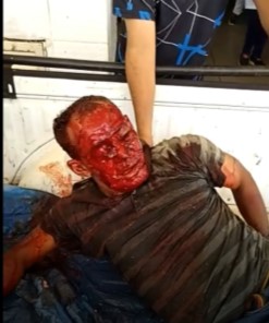 Old man attacked by pitbull