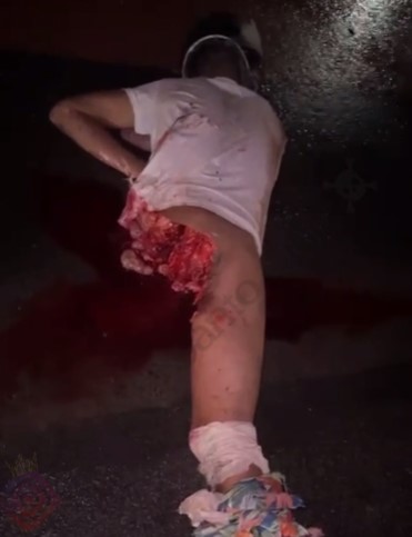 Man turned a body without a leg