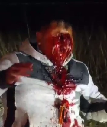 Man Stay Chilling After Losing Both Of His Eyes In Accident