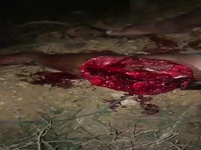 victim and his calf leg ripped off