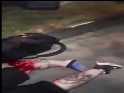 Fat man suffered severe leg injury