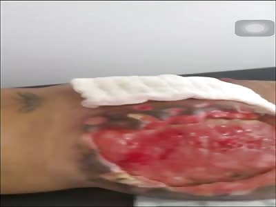 Botched Plastic Surgery in Brazil