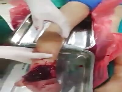 Heel ripped from foot.